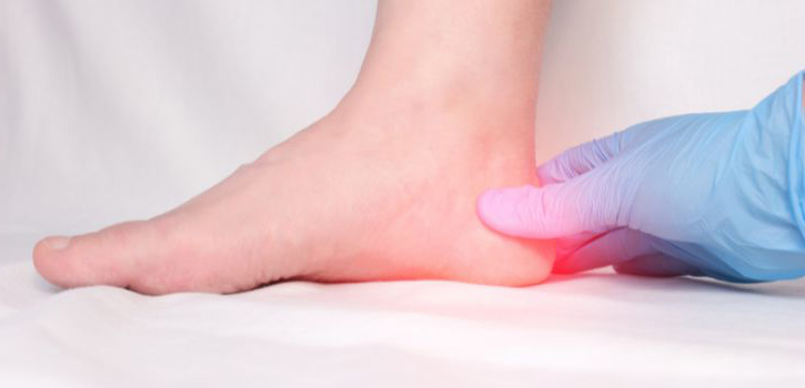 Factores de riesgo y prevención de una fascitis plantar